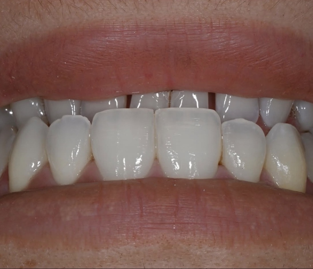 Détail des dents naturelles dans un cas clinique documenté par le Dr Aldo Mazzella