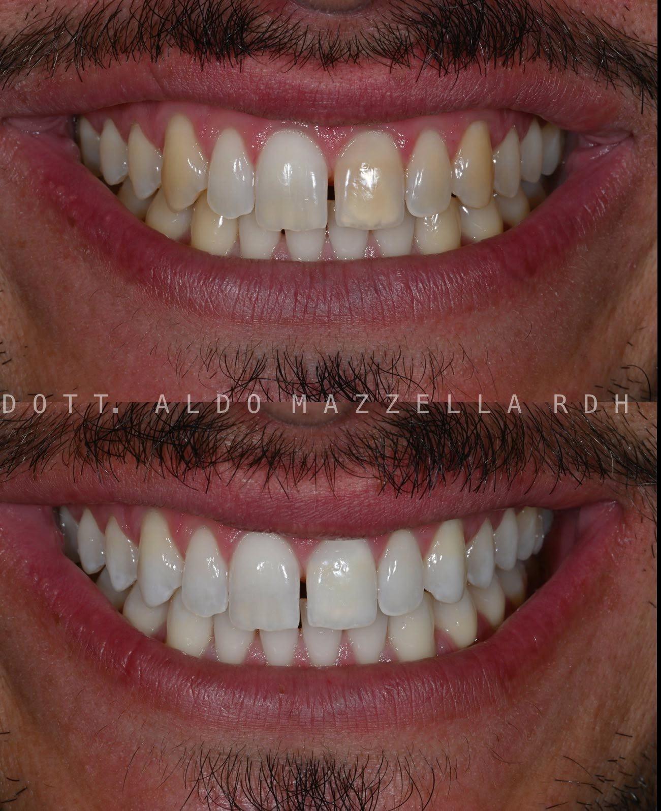 Résultat BlancOne avant/après