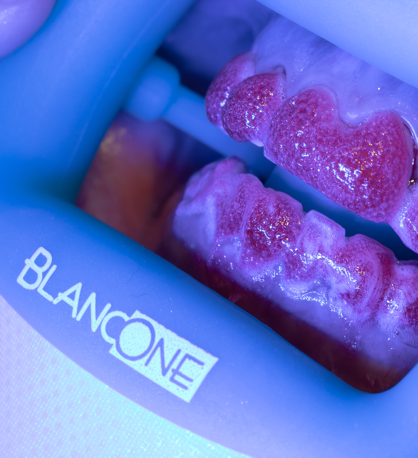 Gel BlancOne à la surface des dents lors d’une séquence d’éclaircissement photoactivée